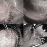 Principais sintomas e tratamento para bicho de olho