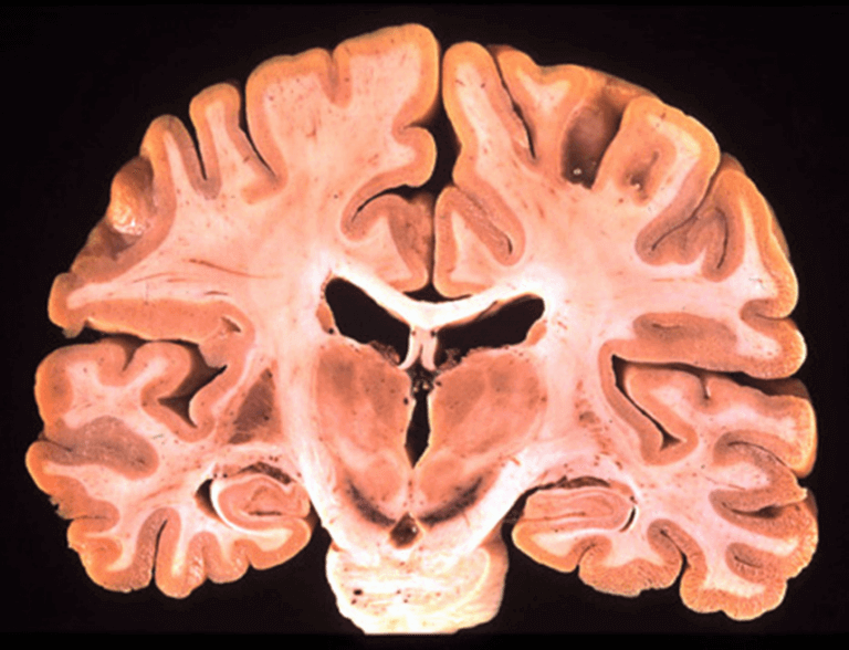 Anatomia do Cérebro centro branco