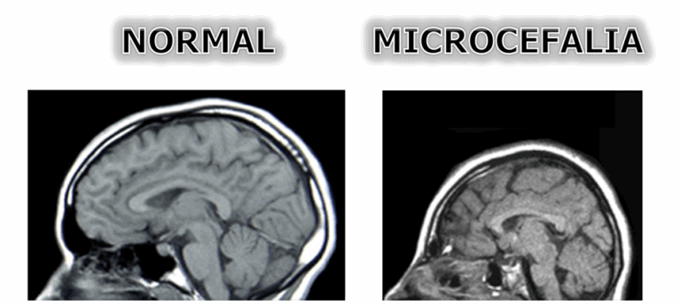 Anatomia do Cérebro normal x microcefalia