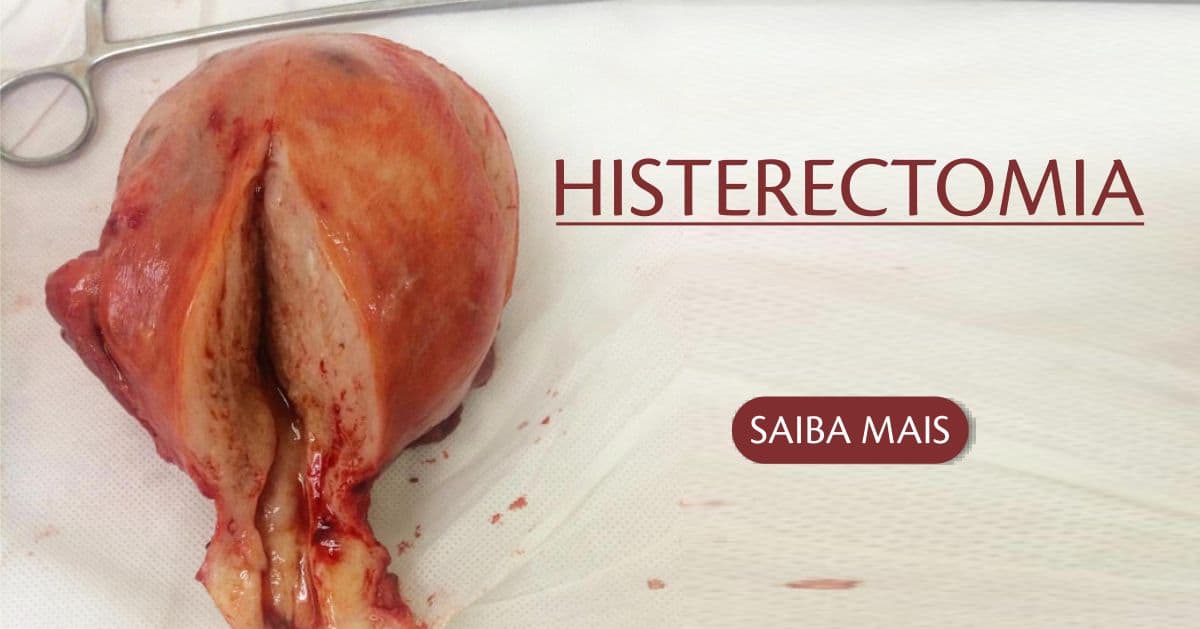 Histerectomia (total, subtotal, radical) - Cirurgia remoção do Útero