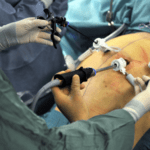 Vídeo: Cirurgia Bariátrica