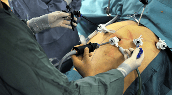 Vídeo Cirurgia Bariátrica