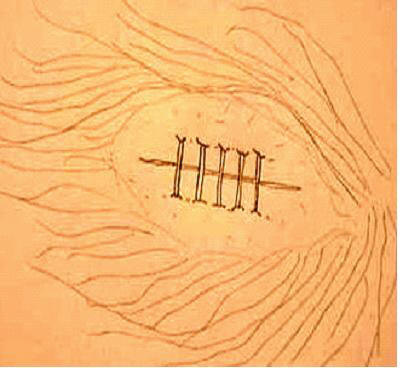 sutura Laceração do couro cabeludo